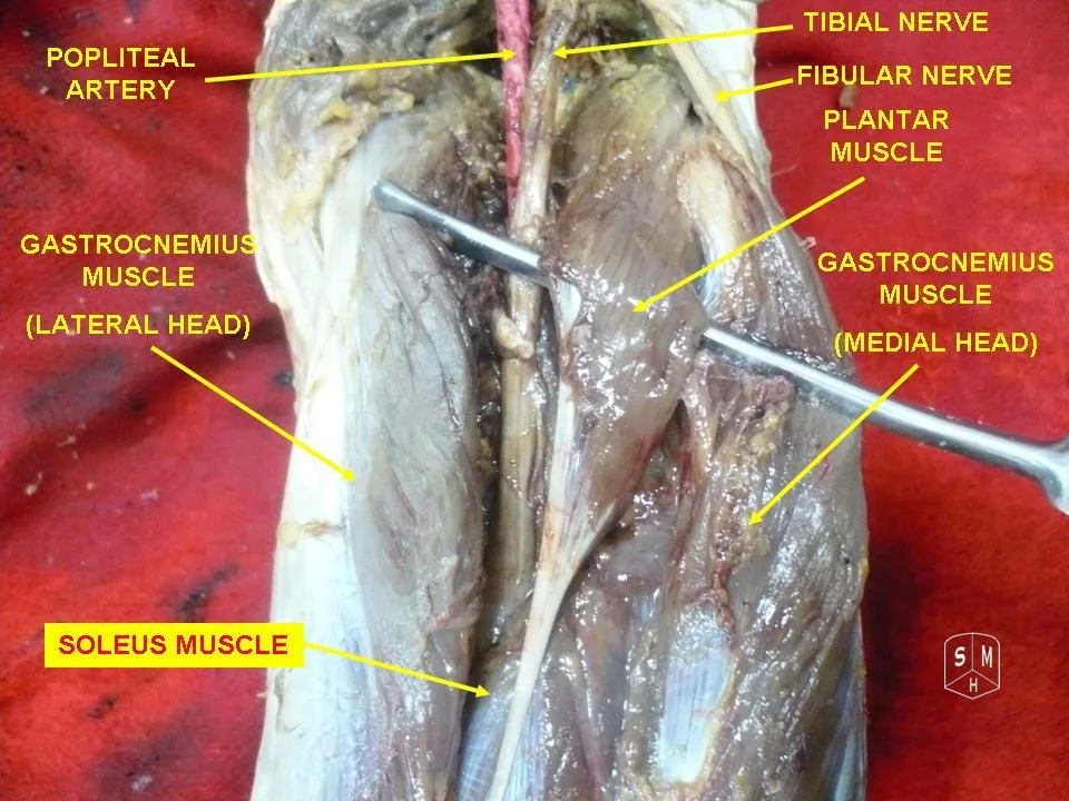 Fotografia preparatu anatomicznego: Mięsień brzuchaty łydki