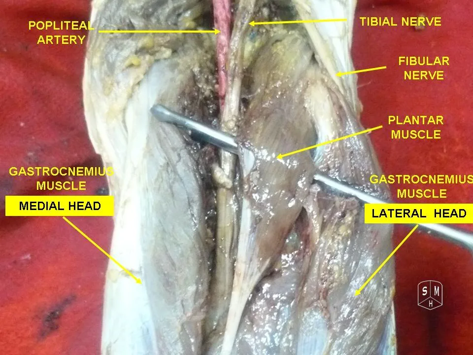 Fotografia preparatu anatomicznego: Mięsień brzuchaty łydki