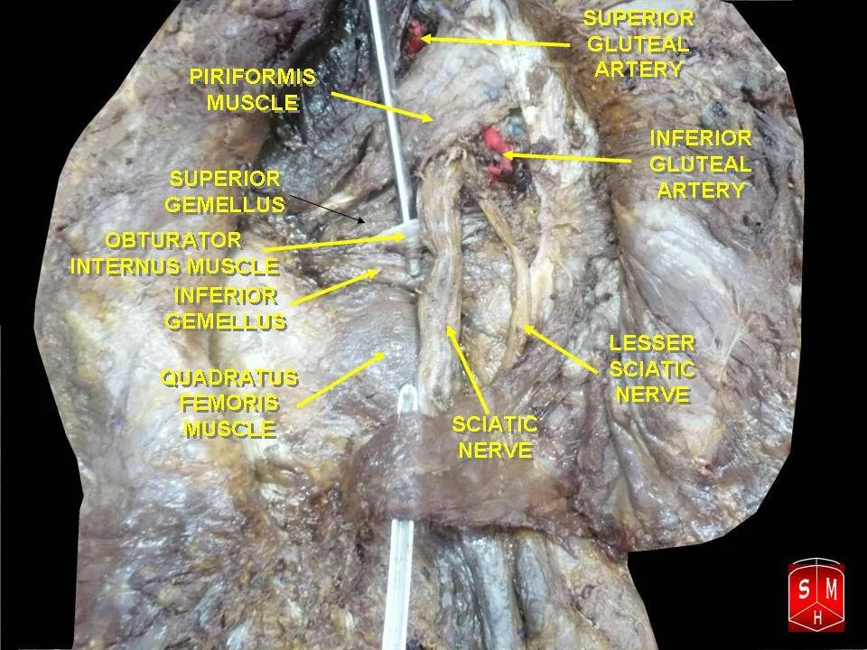 Fotografia preparatu anatomicznego: Mięsień bliźniaczy dolny