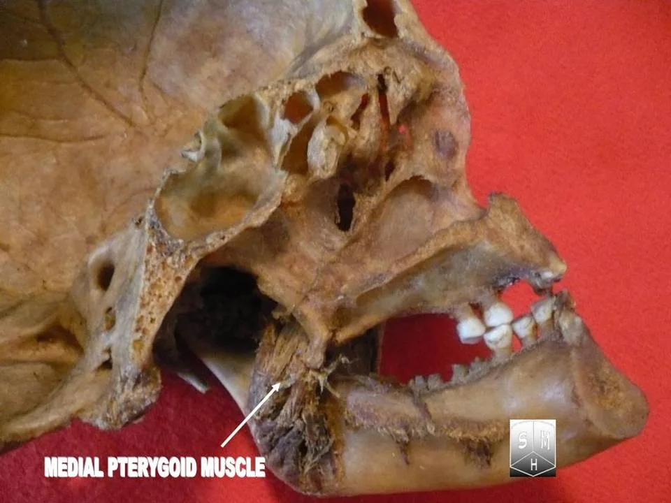 Fotografia preparatu anatomicznego: Mięsień skrzydłowy przyśrodkowy