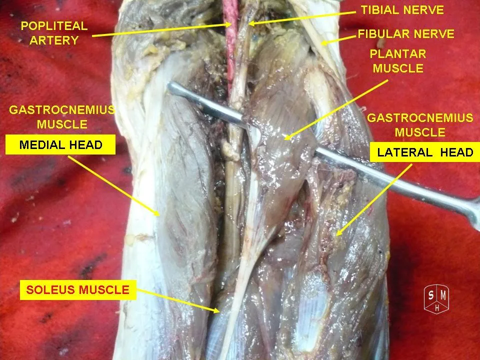 Fotografia preparatu anatomicznego: Mięsień podeszwowy