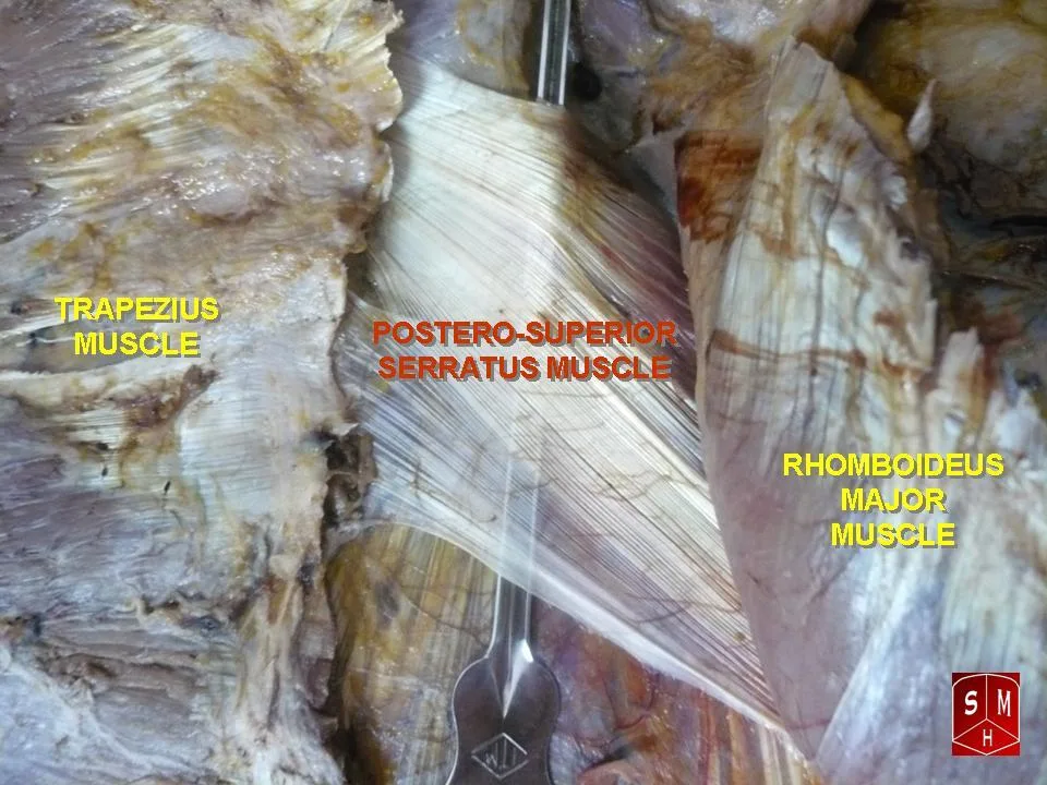 Fotografia preparatu anatomicznego: Mięsień zębaty tylny górny