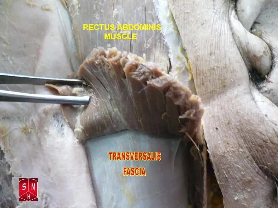 Fotografia preparatu anatomicznego: Mięsień prosty brzucha