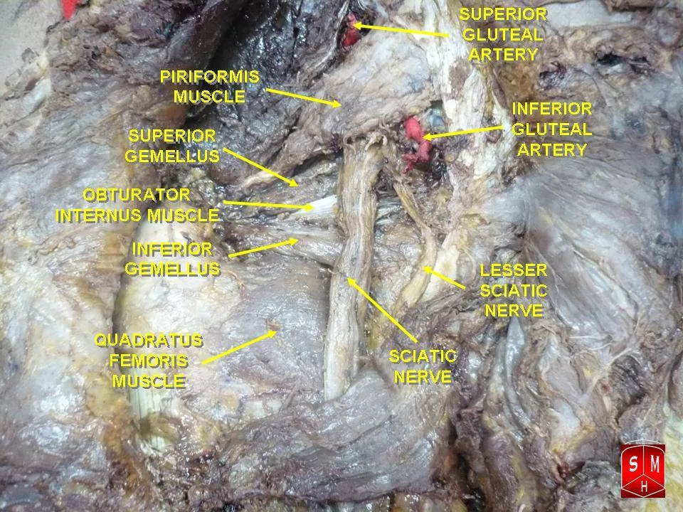 Fotografia preparatu anatomicznego: Mięsień bliźniaczy górny